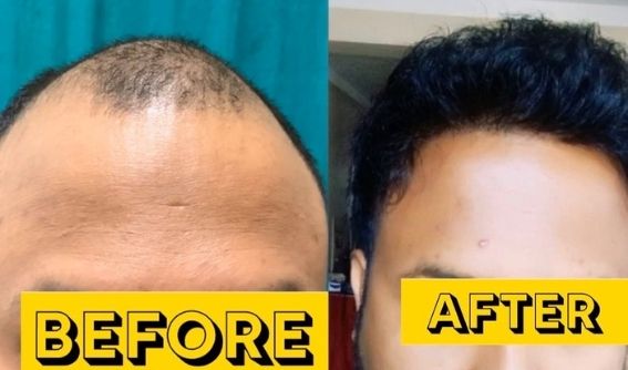 Hair Transplant in Nepal | Price | Procedure & Final Result