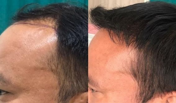 Hair Transplant in Nepal | Price | Procedure & Final Result