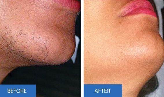 Laser Hair Removal in Nepal | Kathmandu Clinic of Cosmetic Surgery