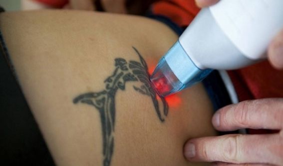 Laser Tattoo Removal in Nepal