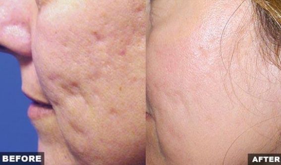 Pimples, Acne Scars, Wrinkles, pores Removal in Nepal