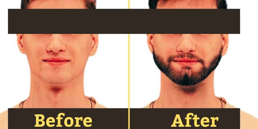 Beard Transplant in Nepal