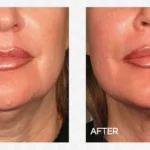 hifu for non surgical facelift and neck lift