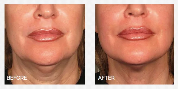 hifu for non surgical facelift and neck lift