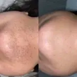 electrolysis hair removal