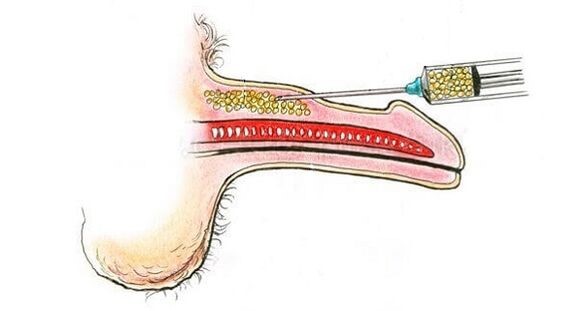 penis enlargement fillers fat grafting in nepal