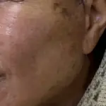 facelift and necklift in nepal