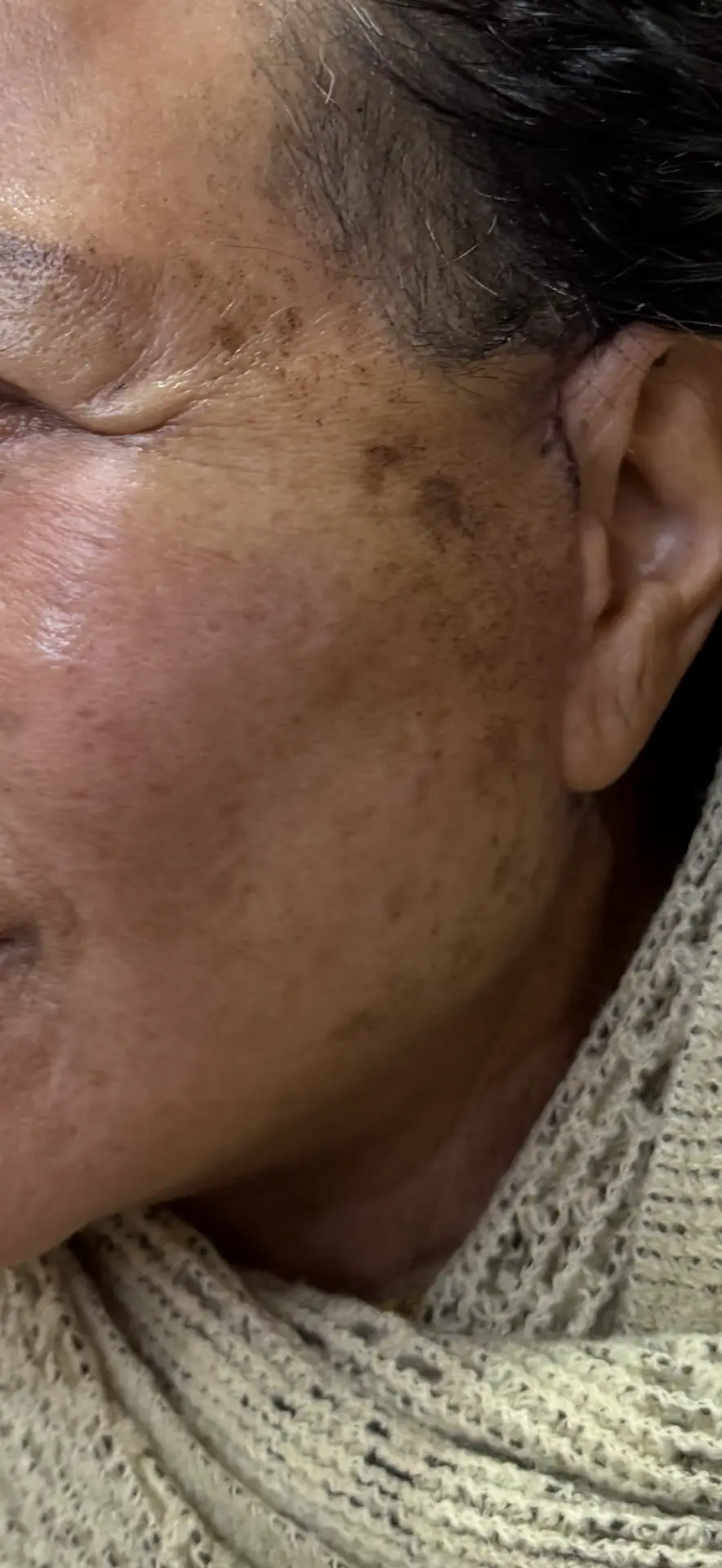 facelift and necklift in nepal